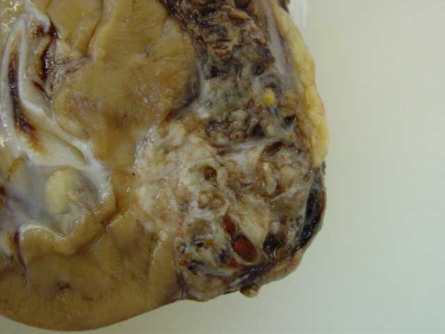 Fig. 2 - Lesin slida, con reas necrohemorragicas.